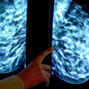 The hormonal coil may be linked to increased risk of breast cancer, researchers say (Rui Vieira/PA)